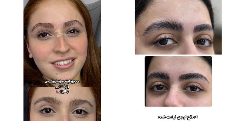 اصلاح ابروی لیفت شده